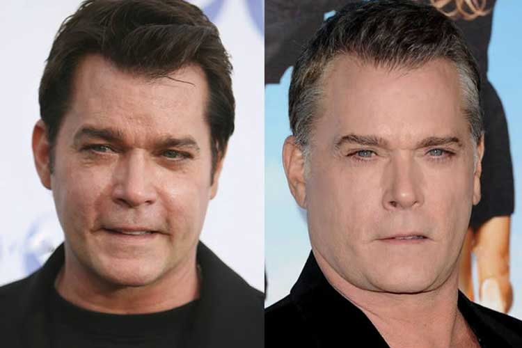 Ray Liotta Plastic Surgery: Facelift, Botox, Hair Transplantation