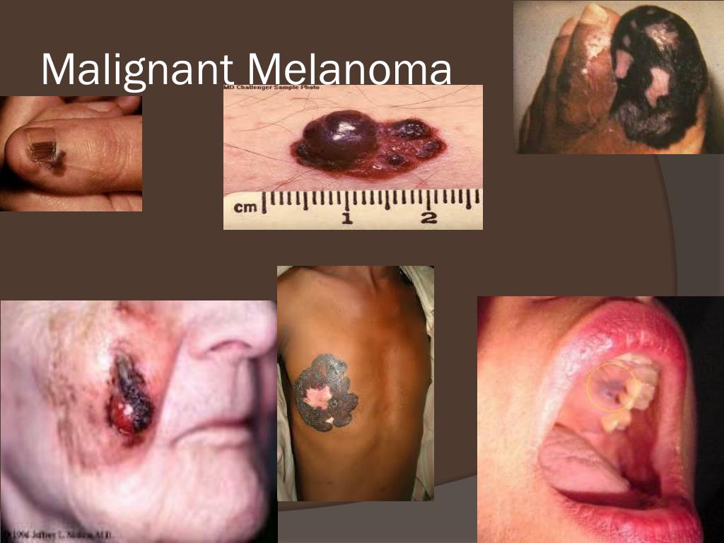 PPT - Malignant Melanoma PowerPoint Presentation, free download - ID ...