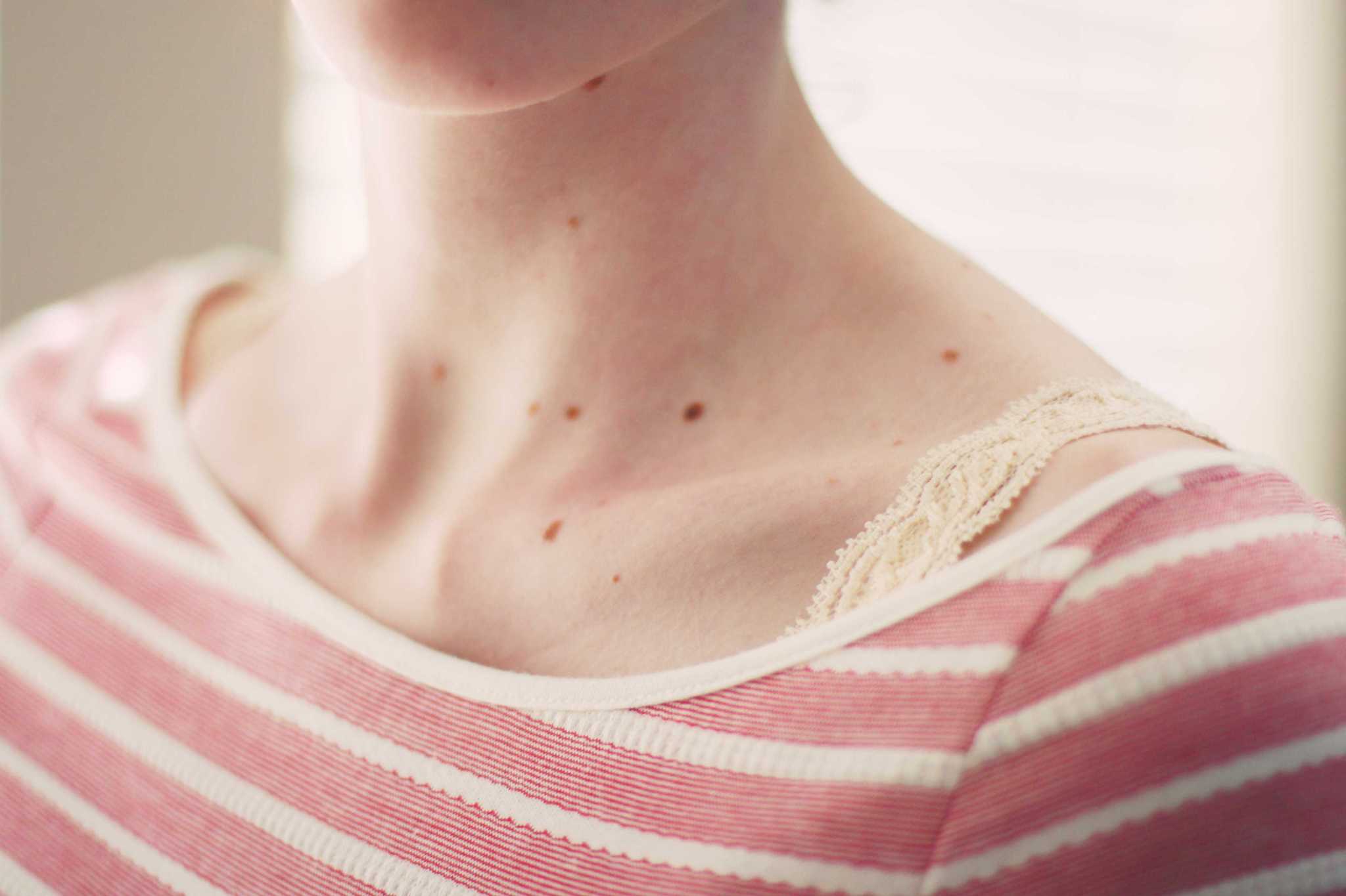 13 photos of skin spots and what caused them
